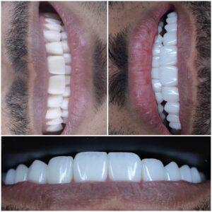 افضل ابتسامة فينيرز في ابوظبي والامارات افضل عيادة اسنان في ابوظبي